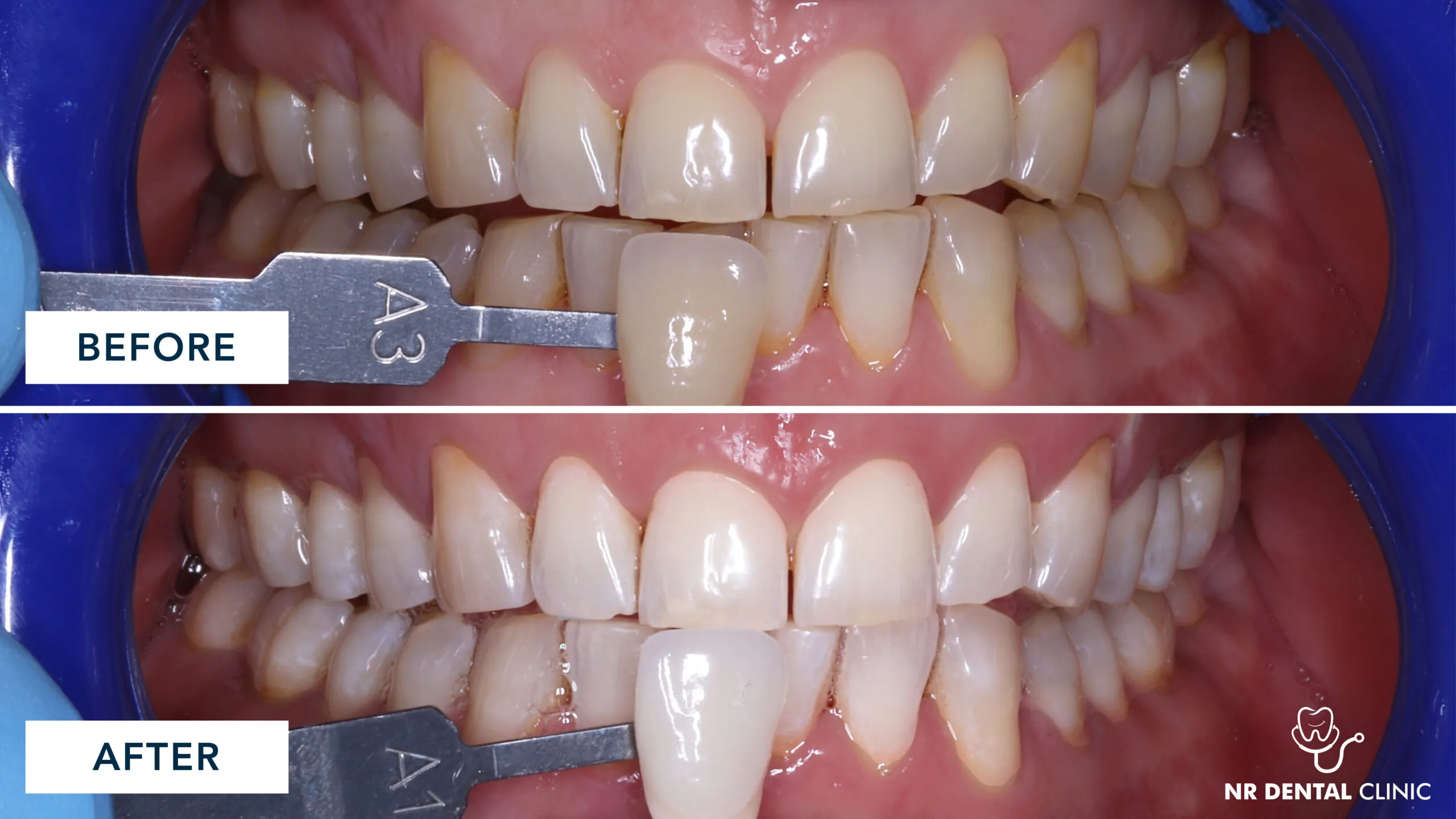 /img/33162-invisalign-and-teeth-whitening-7.webp
