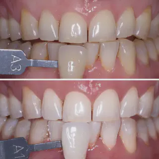 /img/33162-invisalign-and-teeth-whitening-7.webp