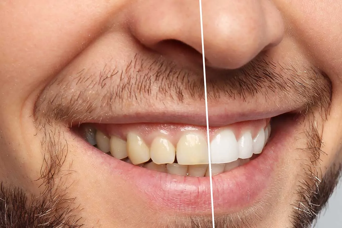 33164 whitening strips