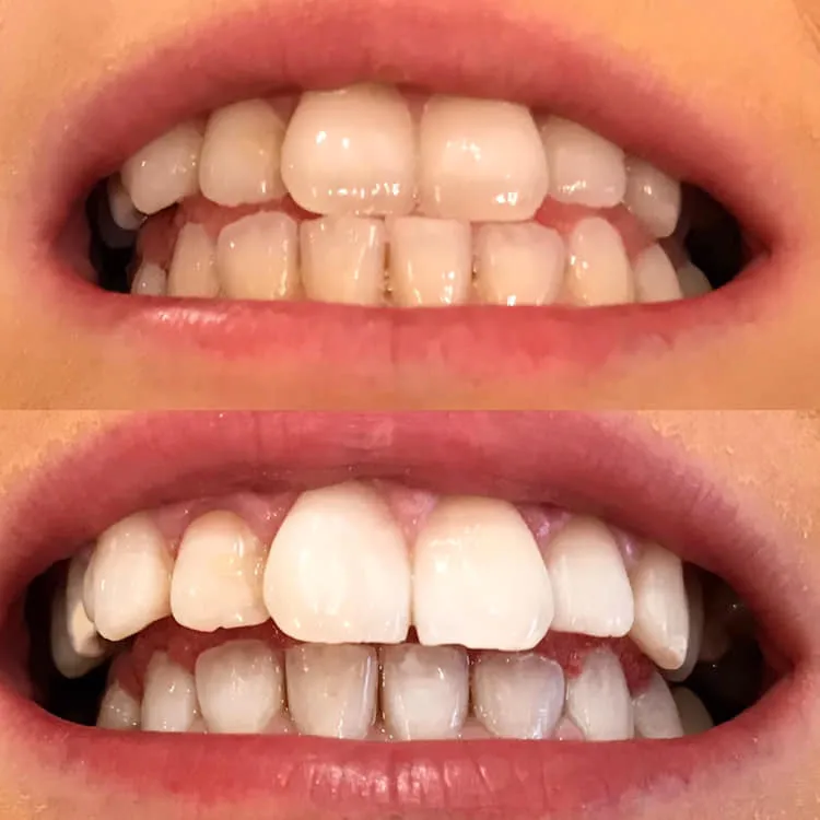 33165 foods to avoid teeth whitening