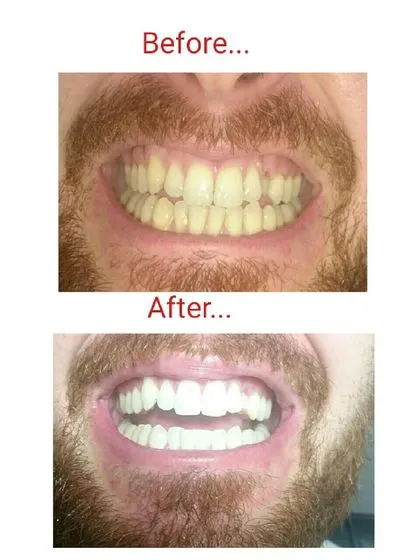 /img/33165-laser-teeth-whitening-cost.webp