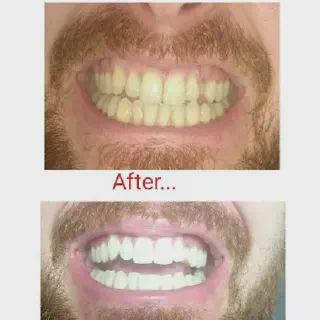 /img/33165-laser-teeth-whitening-cost.webp