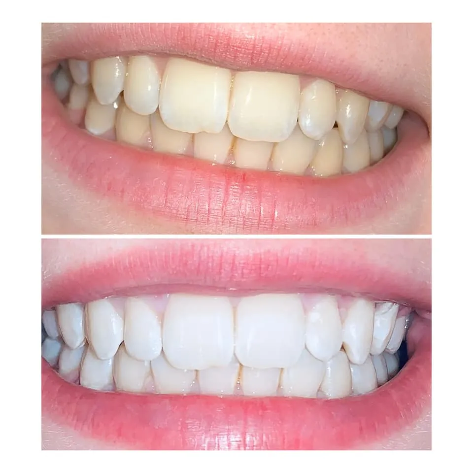 33165 laser teeth whitening procedure