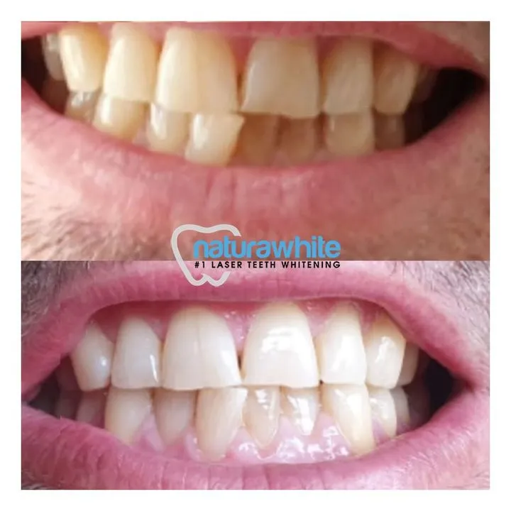 33165 laser teeth whitening yorkshire