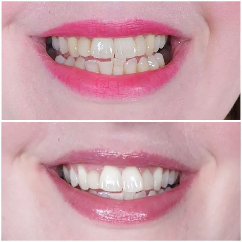 33165 teeth whitening aftercare