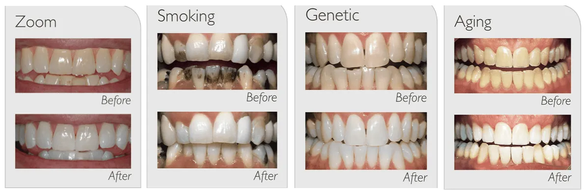 33169 professional teeth whitening