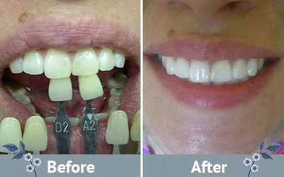 33169 teeth whitening before after