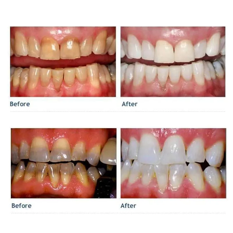 33174 nano teeth whitening application