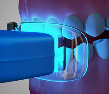 33175 in office teeth whitening
