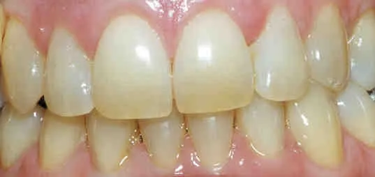 33175 teeth whitening cost