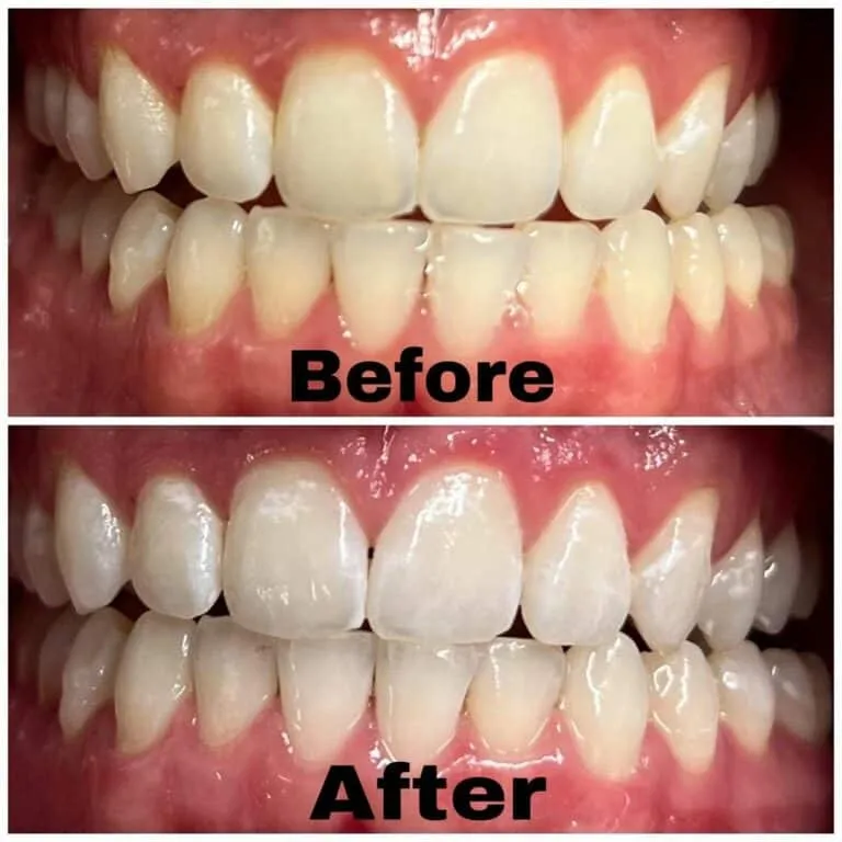 33176 at home teeth whitening stjohns