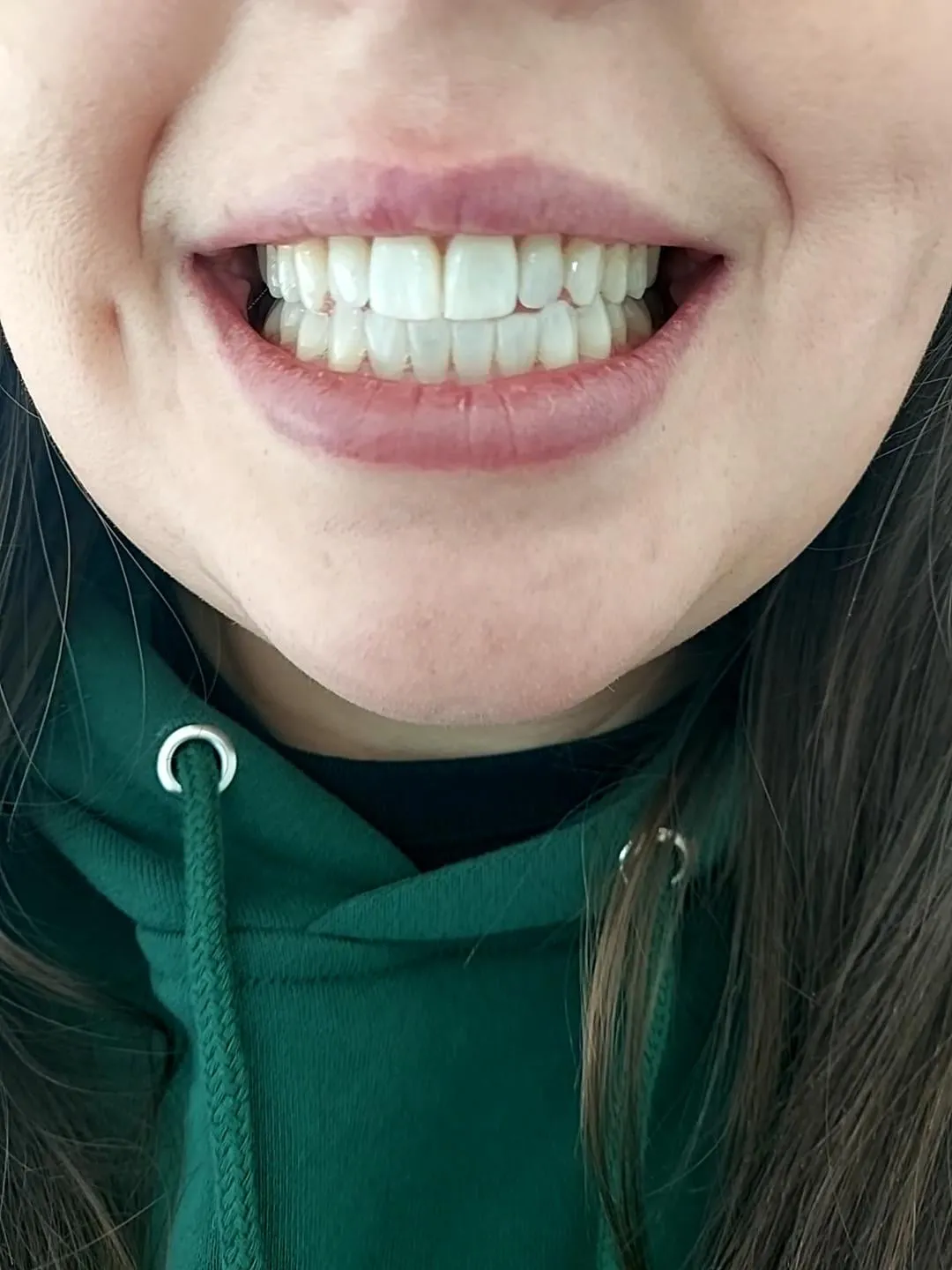 /img/33177-professional-whitening.webp
