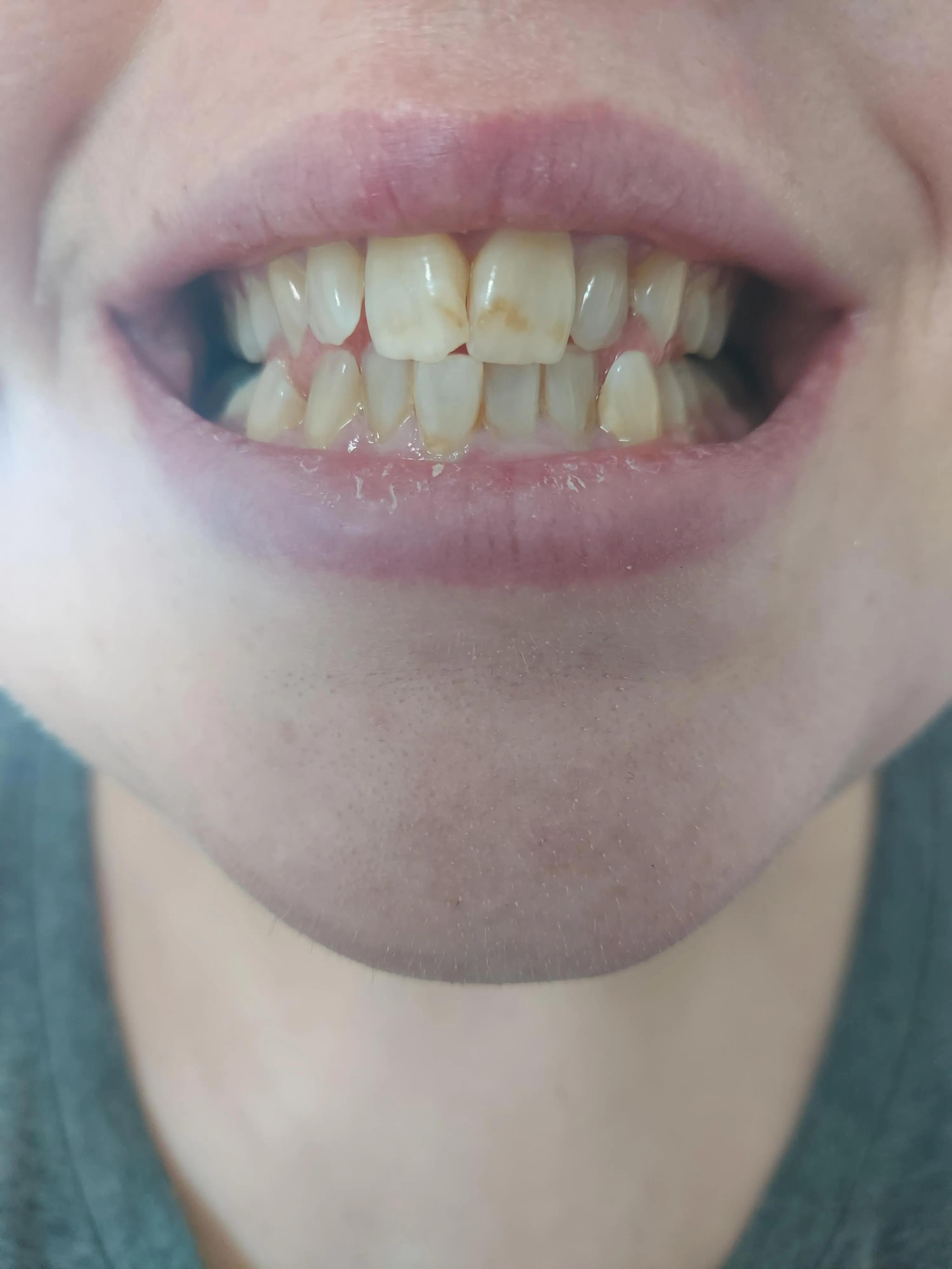 33177 smile makeover