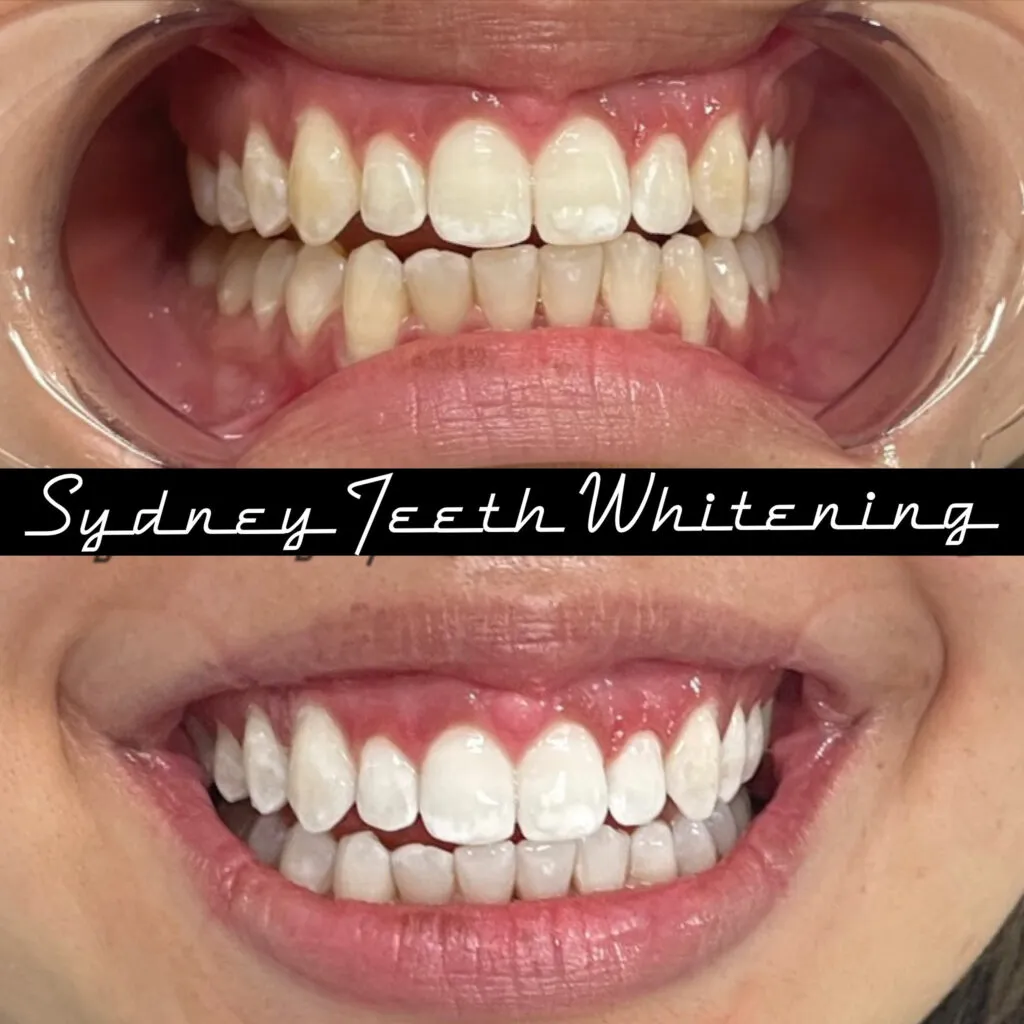 33179 smoking teeth
