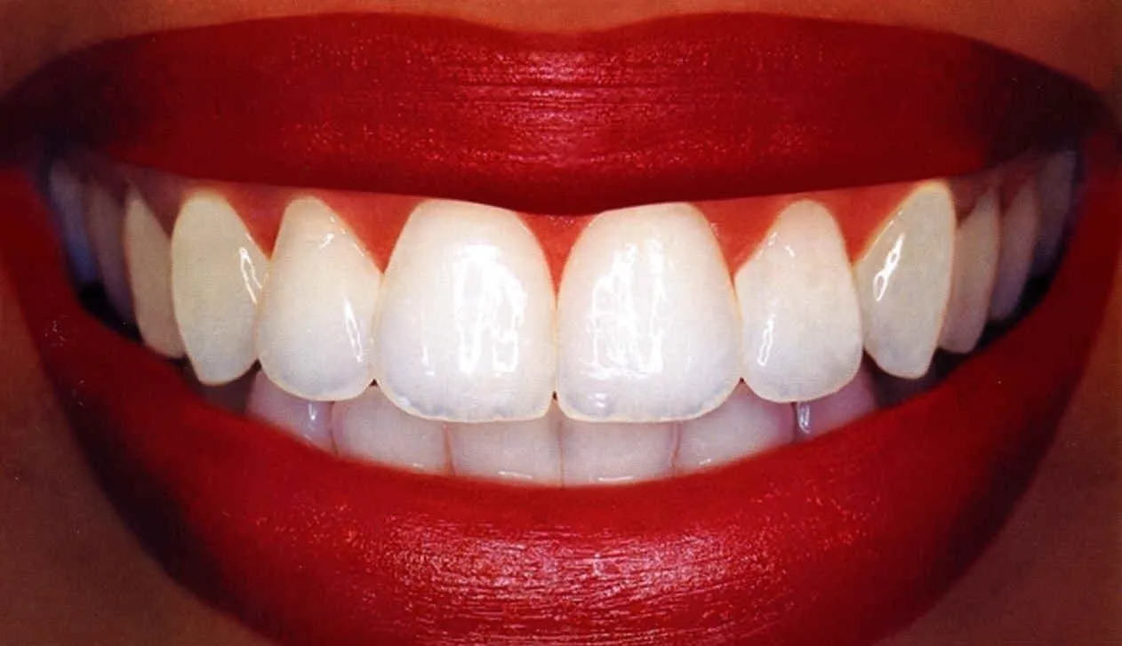 33180 professional teeth whitening