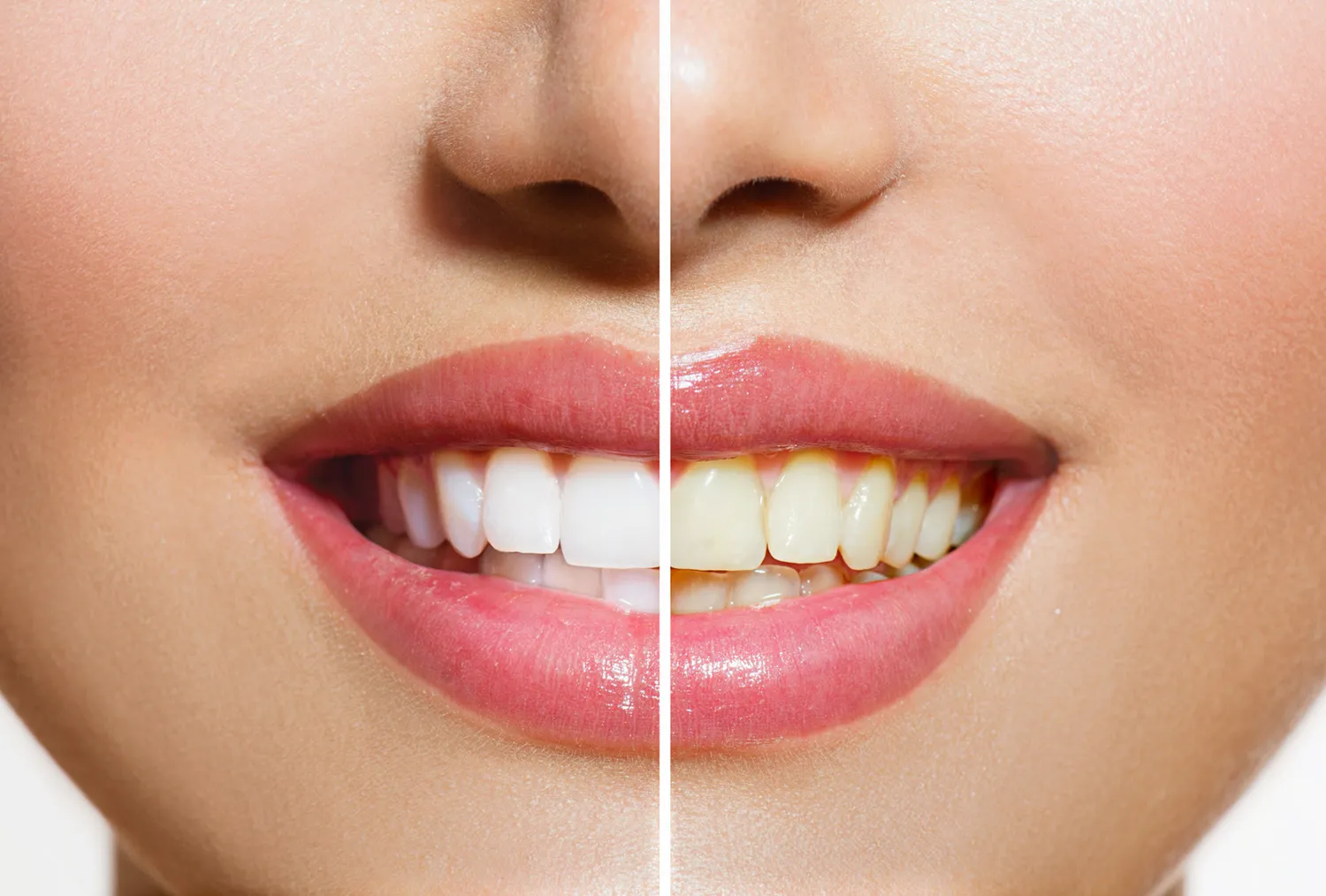 33180 teeth whitening dazzling smile