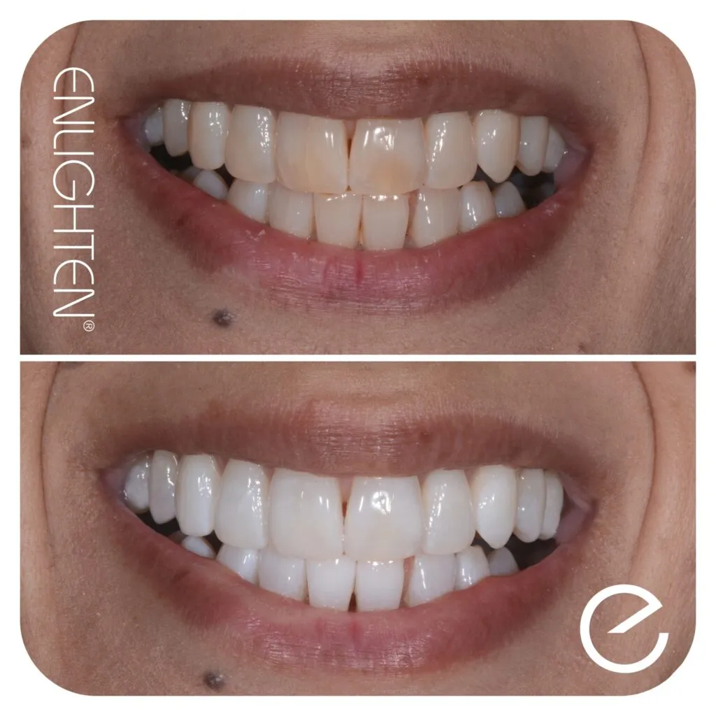 33183 teeth whitening miles benefits