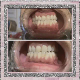 /img/33183-teeth-whitening-miles-results.webp
