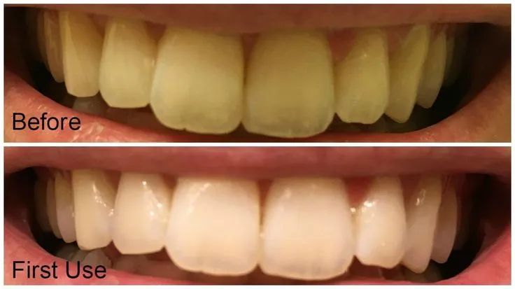 33187 applying whitening gel