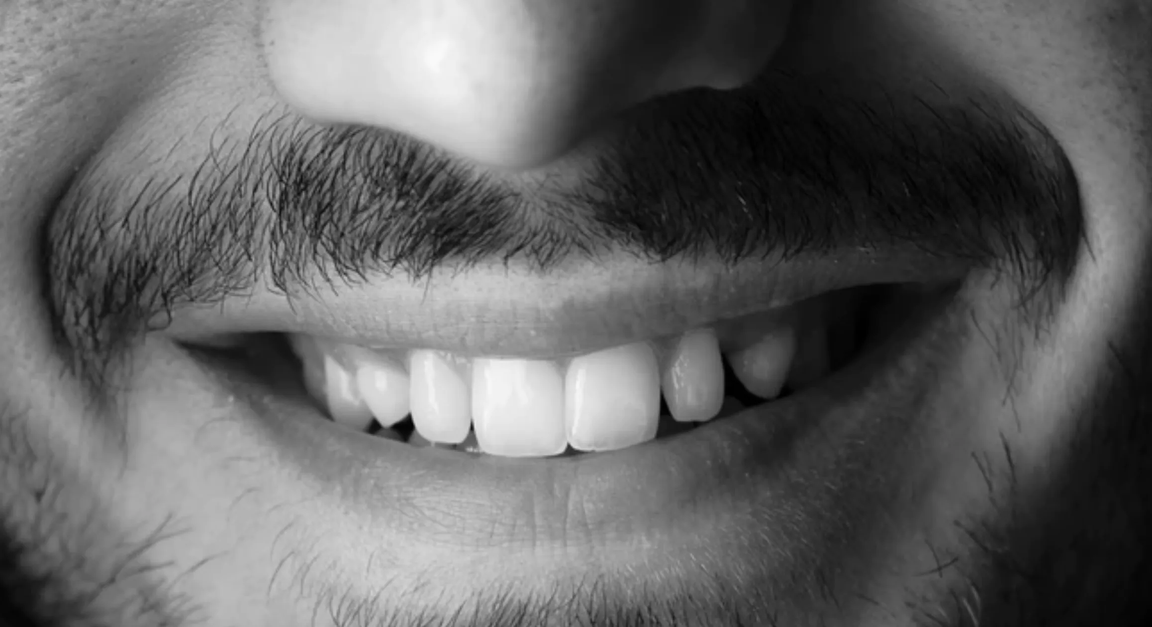 33192 veneer whitening professional