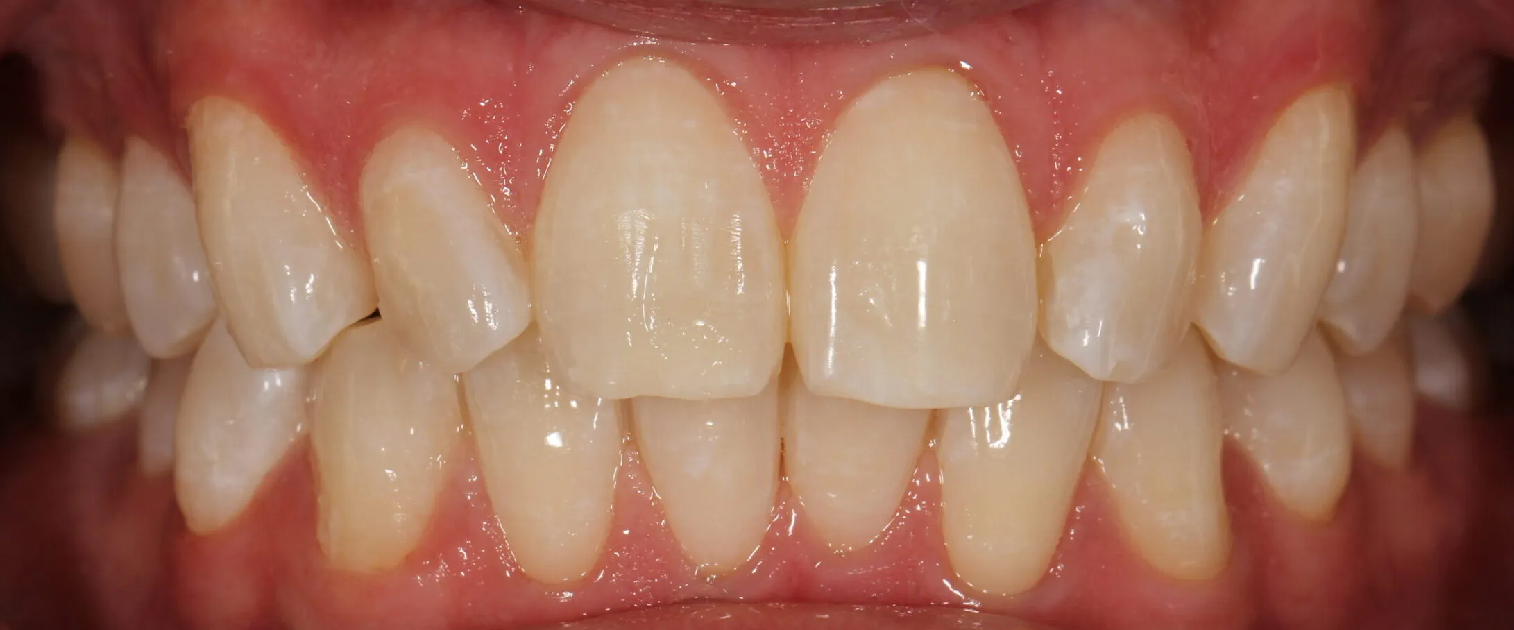 33194 sensitive teeth