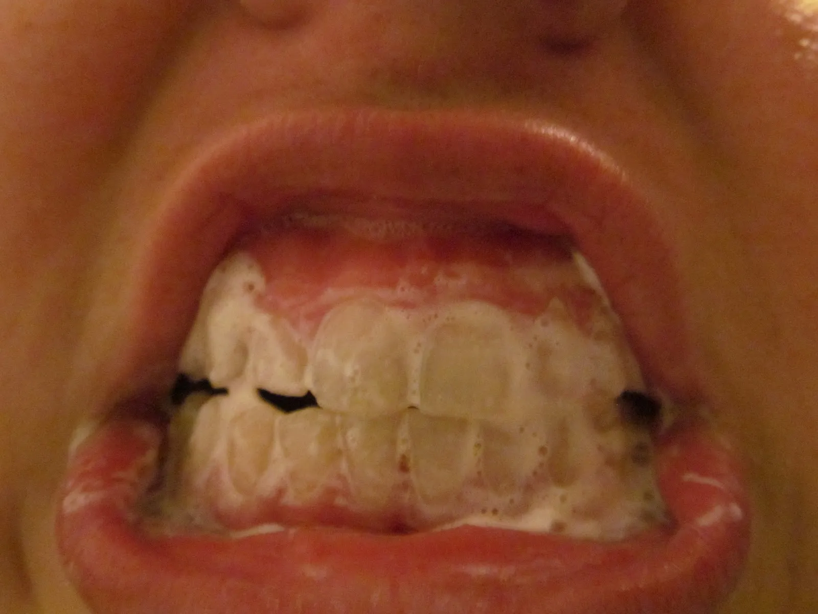 /img/33194-teeth-whitening-solutions.webp