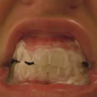 /img/33194-teeth-whitening-solutions.webp
