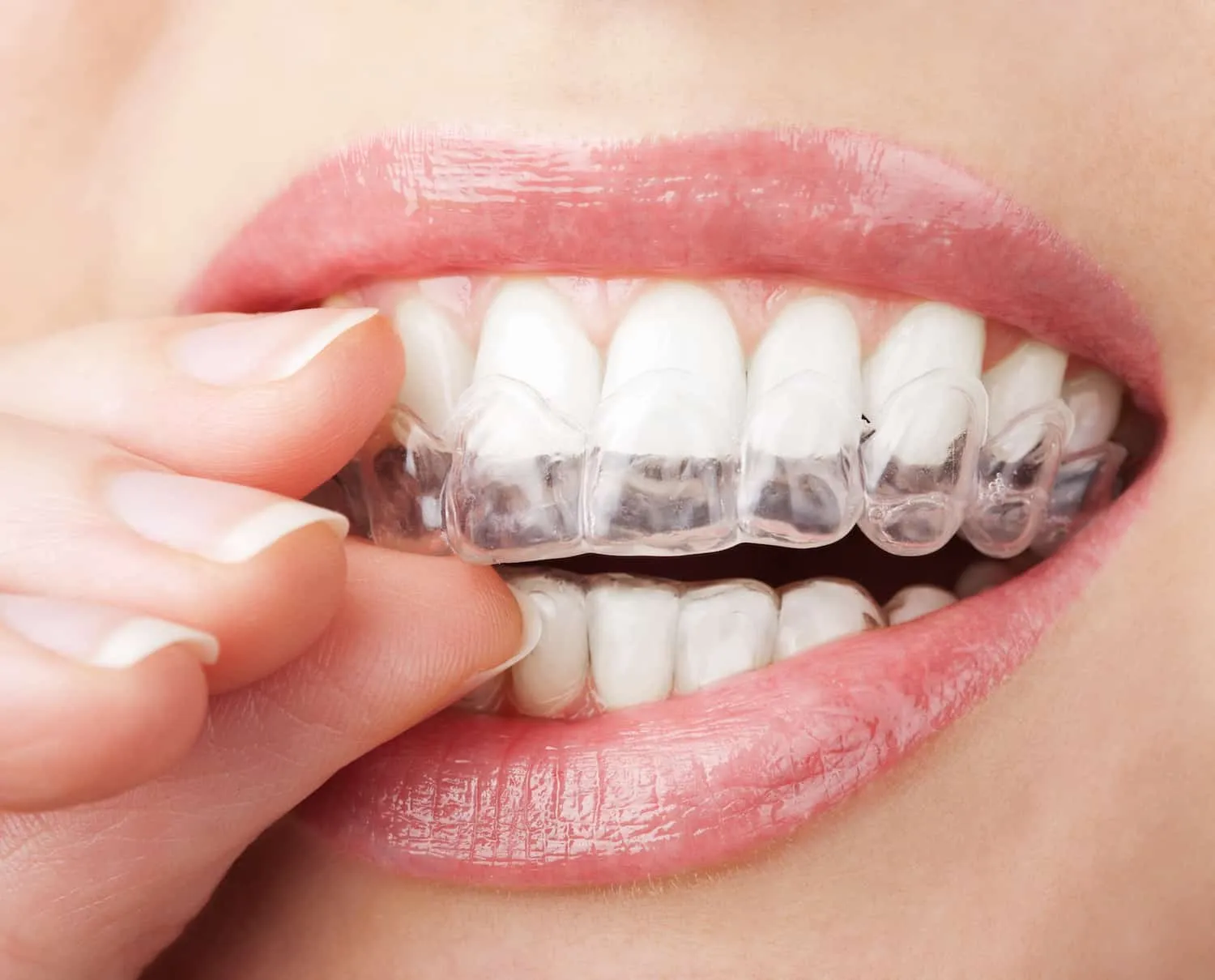 33194 tooth discoloration