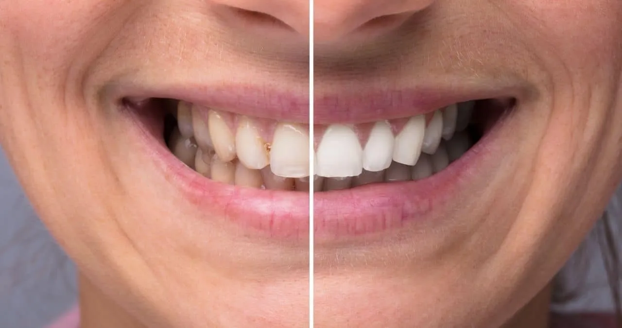 33194 uneven whitening