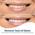 33196 discoloration teeth image