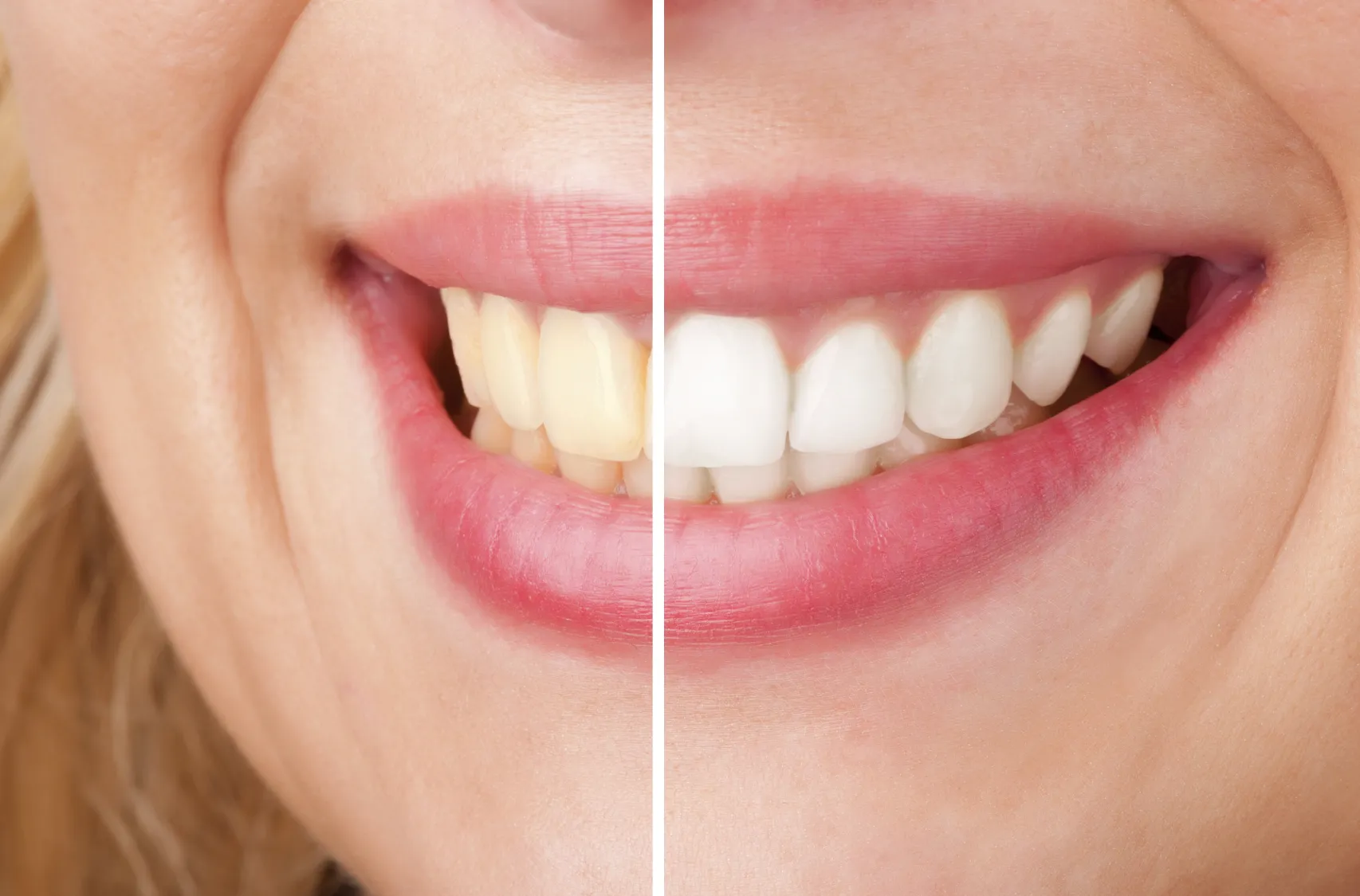 33196 whitening strips image