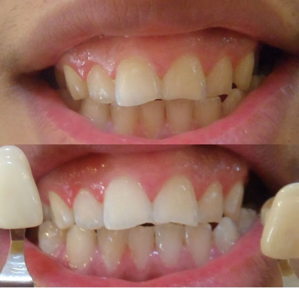 33199 at home teeth whitening