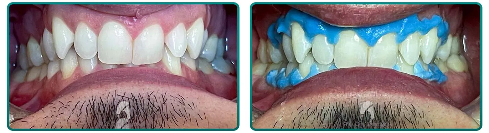 33201 at home whitening kit