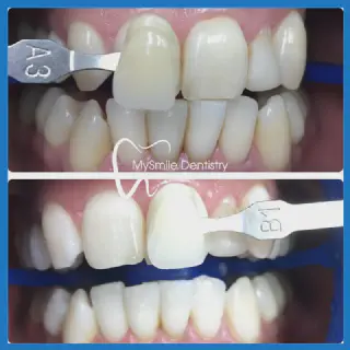 /img/33201-healthy-smile.webp