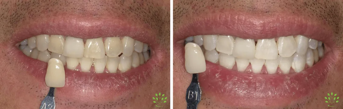 33204 fluoride treatment