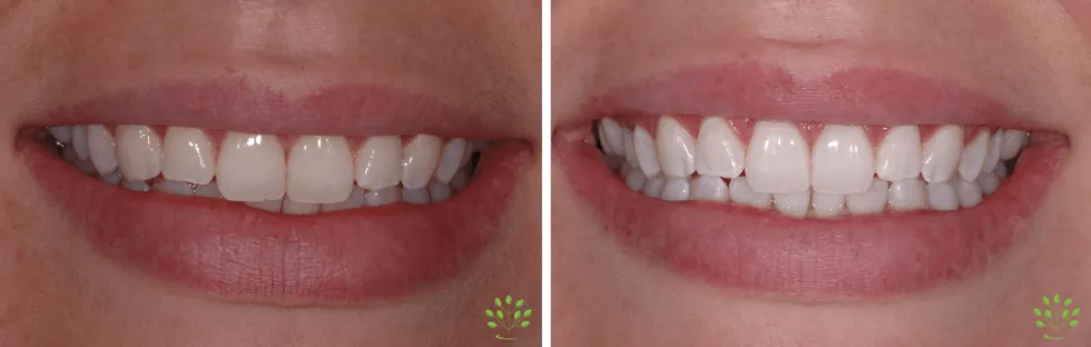/img/33204-zoom-whitening-results.webp