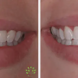 /img/33204-zoom-whitening-results.webp