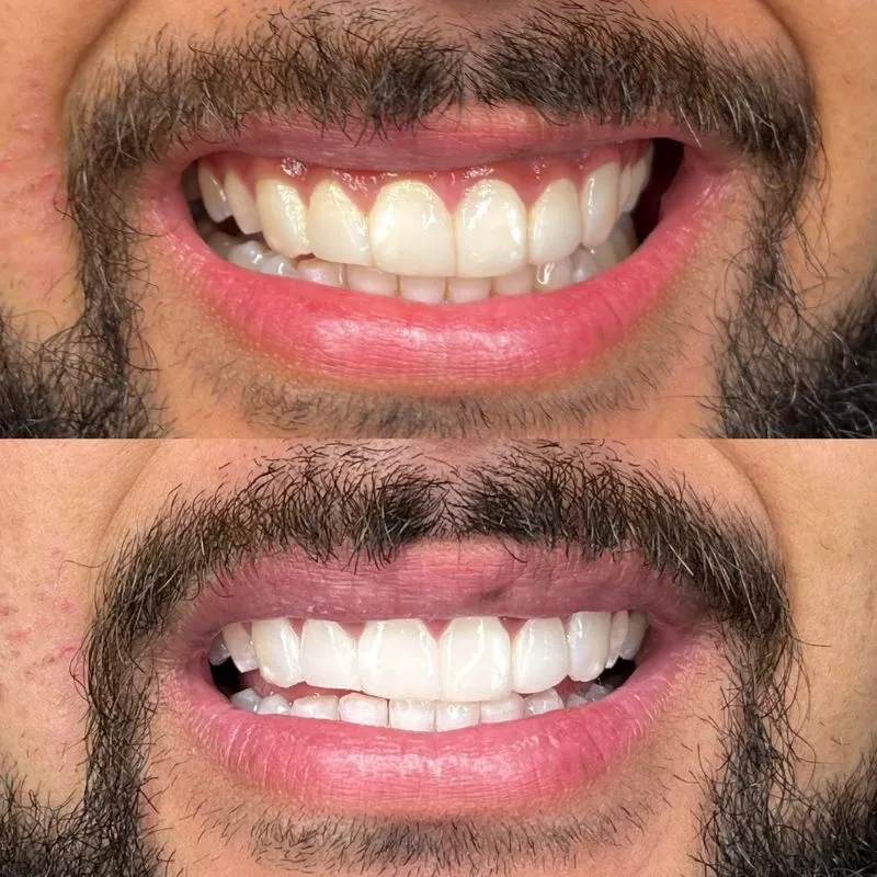 33205 teeth whitening indonesia cost