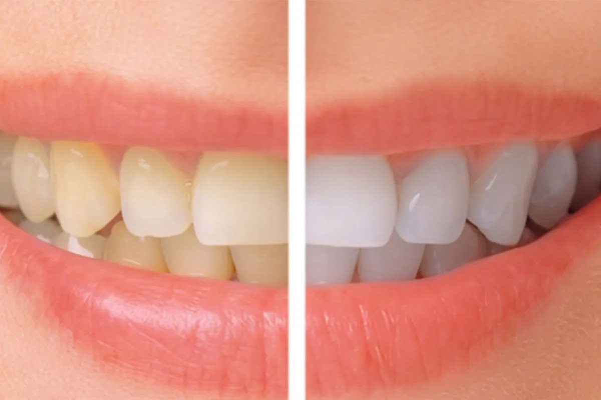 33205 teeth whitening indonesia oral health