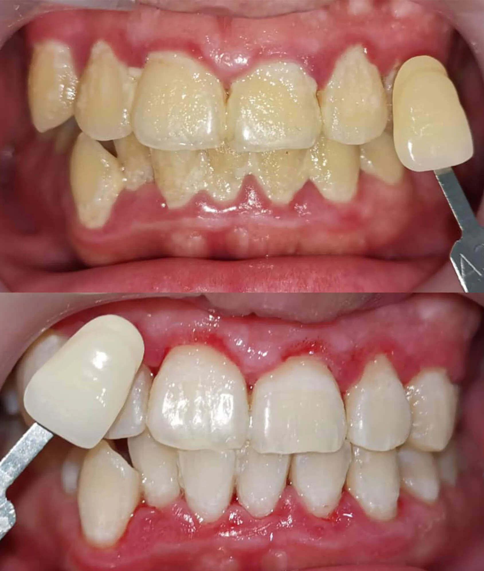 33205 teeth whitening indonesia stain removal