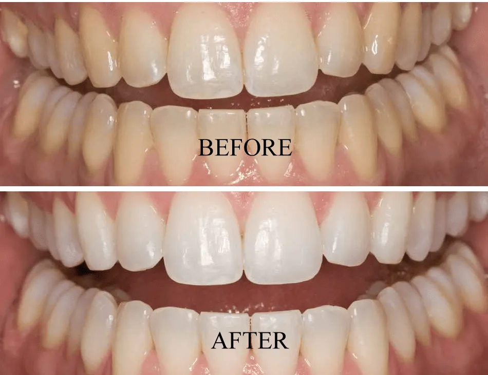 33207 at home teeth whitening dc