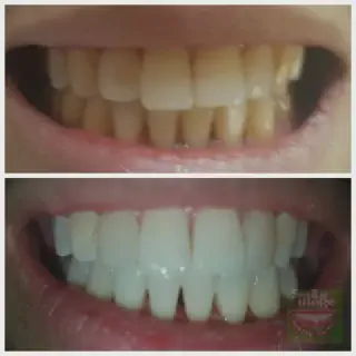 /img/33213-teeth-whitening-philippines-aftercare.webp