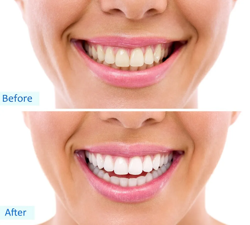 33215 professional whitening
