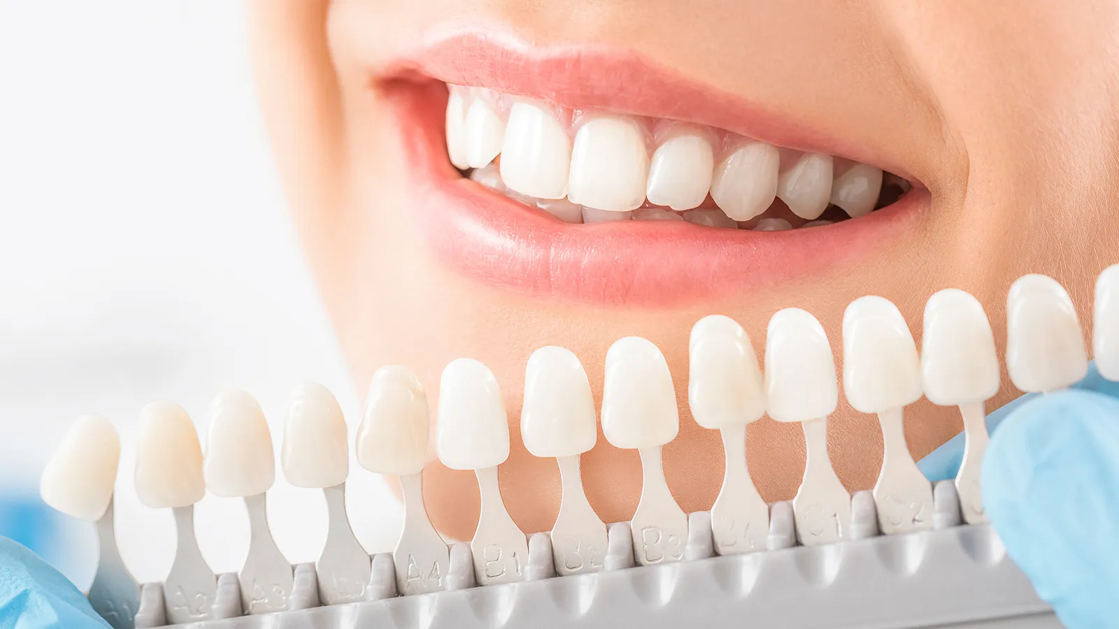 33216 in office teeth whitening