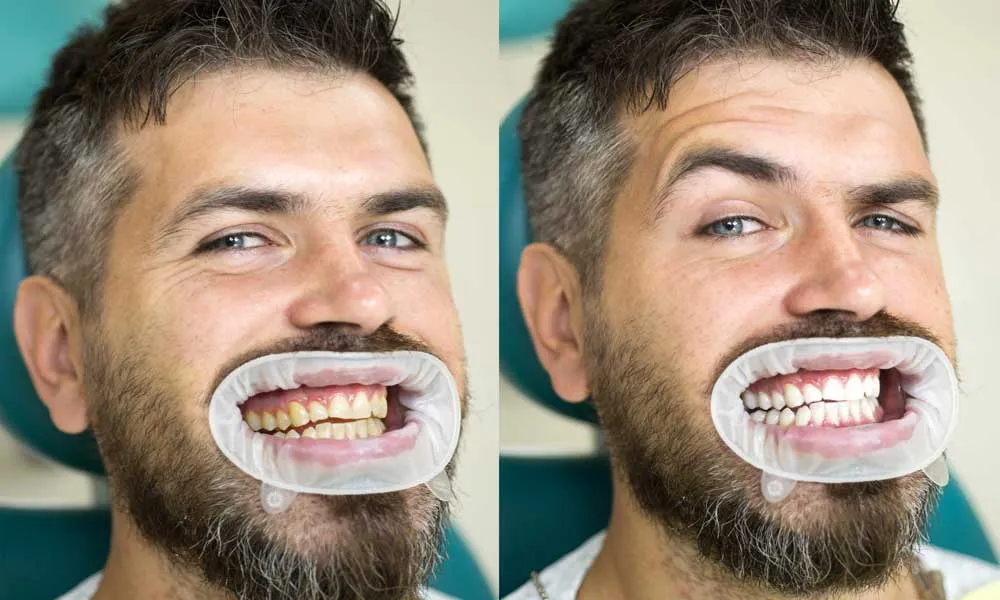 33216 teeth whitening process