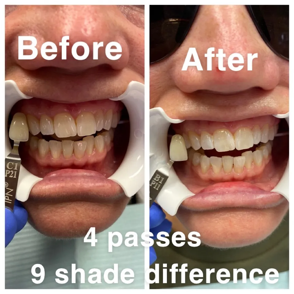 33217 in office teeth whitening