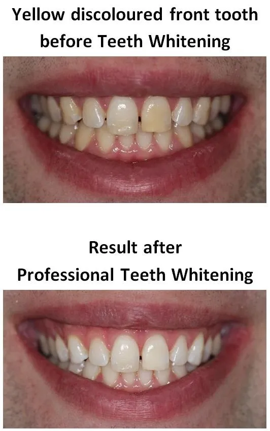 33217 teeth whitening at home trays