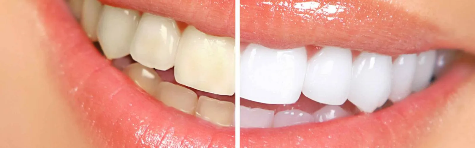 /img/33217-teeth-whitening-sensitivity.webp