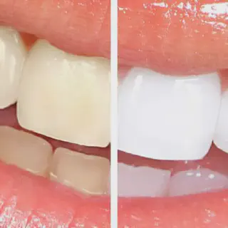 /img/33217-teeth-whitening-sensitivity.webp