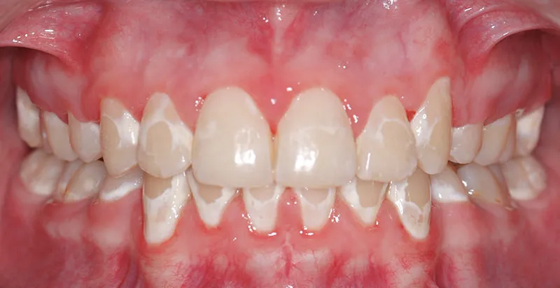 33221 demineralization of teeth